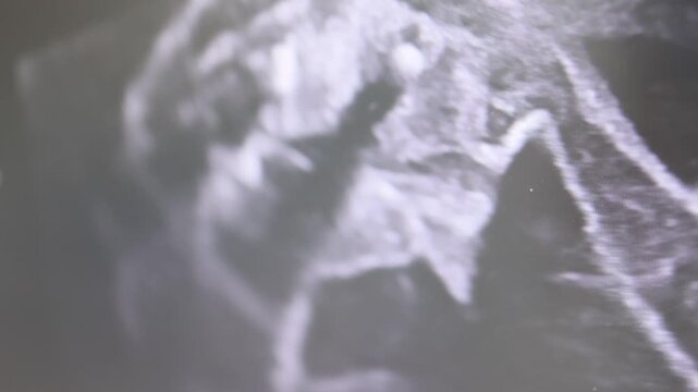 Ultrasound image of male fetus during prenatal screening. Visible primary genitalia in the womb. Medical examination to determine sex of the baby and monitor fetal development