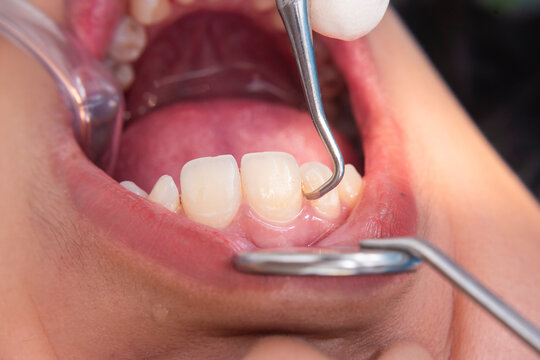 Macro image of dental scaling on lower anterior teeth using a metal scaler to remove plaque and calculus near the gum line.