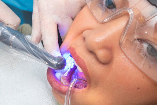 A dentist uses a polymerization light to cure composite material during the filling process on a patient's lower premolar tooth.