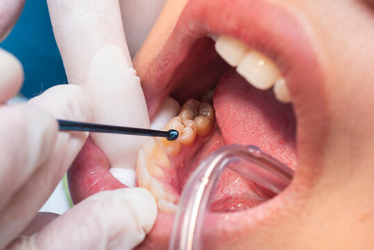 A dental professional places composite resin into a prepared cavity on the lower premolar using a ball burnisher or applicator.