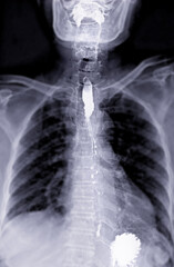 Fluoroscopic footage of a barium swallow test showing real-time esophageal function, used to assess dysphagia, GERD, and structural abnormalities.