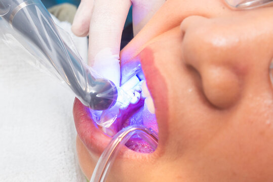 Final polymerization phase of dental composite using curing light on a lower premolar to harden the restoration material securely.