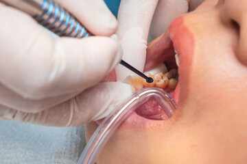 Macro view of dental professional inserting composite into a lower premolar cavity using a delivery...