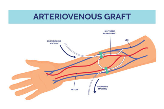 Arteriovenous graft. Venous fistula catheter, central blood acces hemodialysis machine dialysis surgery malformation disease treatment arm vein infographic vector illustration