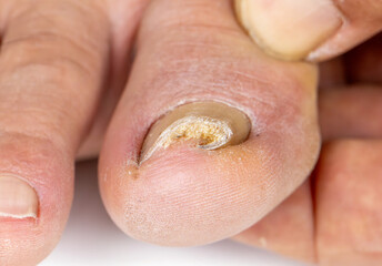 Ingrown toenail on a senior feet with white background
Close-up ingrown toenail on senior feet with...