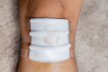 knee wound, close-up, injured knee with gauze and medical tape after first aid treatment,...