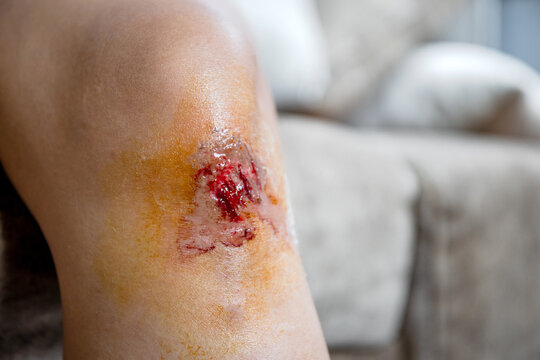 Knee wound, Fresh wound on my knee is from an accident, Skin wound, Representing wound care, First aid, and personal health, close-up