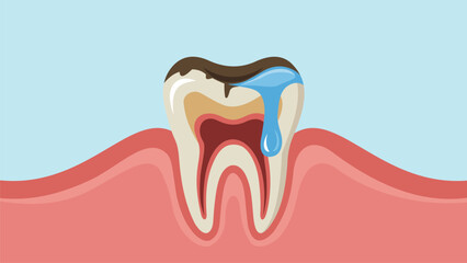 Tooth Decay Illustration of a Decaying Tooth with Water Droplet