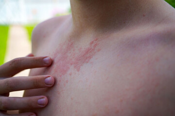Skin Scratching an itch. Sensitive Skin, Food allergy symptoms, Irritation.