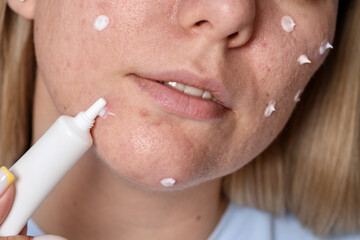 Woman applying cream onto face, closeup. Acne treatment