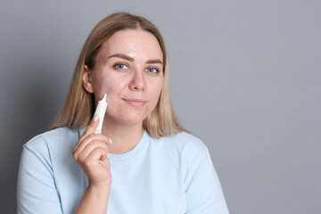 Woman applying cream onto face on grey background, space for text. Acne treatment