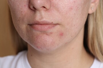 Obraz premium Woman with acne problem on beige background, closeup