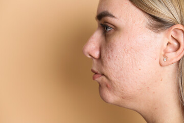 Woman with acne problem on beige background, space for text