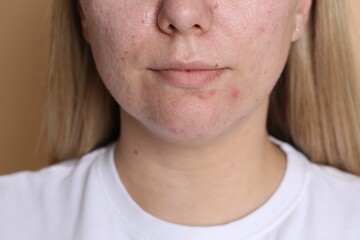 Obraz premium Woman with acne problem on beige background, closeup
