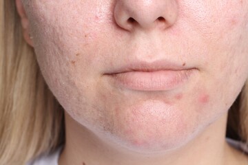 Fototapeta premium Closeup view of woman with acne problem