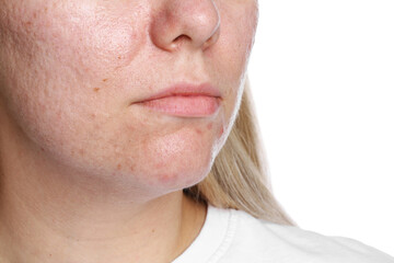 Fototapeta premium Woman with acne problem on white background, closeup