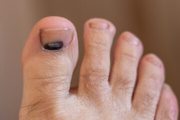 Close-up of toes with a bruised and discolored big toenail, indicating an injury