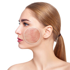 Young woman with couperose on face skin in zoom circle.
