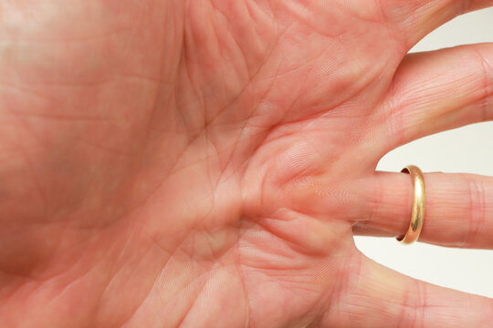 Senior Man with Dupuytren Contracture on the palm of his hand