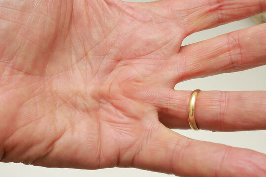 Senior Man with Dupuytren Contracture on the palm of his hand