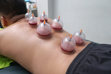 Asian male lying down as a therapist performs cupping therapy, with several cups placed on his back. Traditional treatment for muscle relief, relaxation, and improved circulation