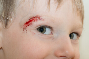 Close-up of the boy's face with a sadina. The child treats the wound on the face. High quality photo