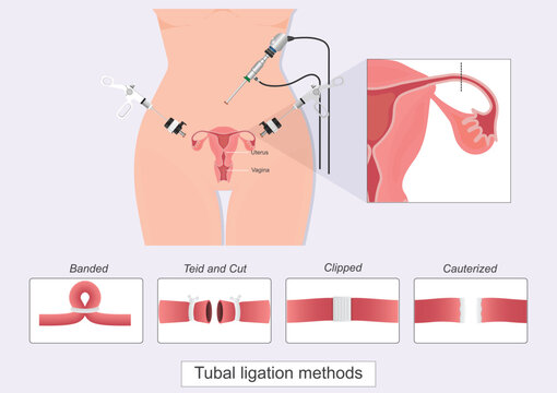 Tubal ligation is a type of permanent birth control.