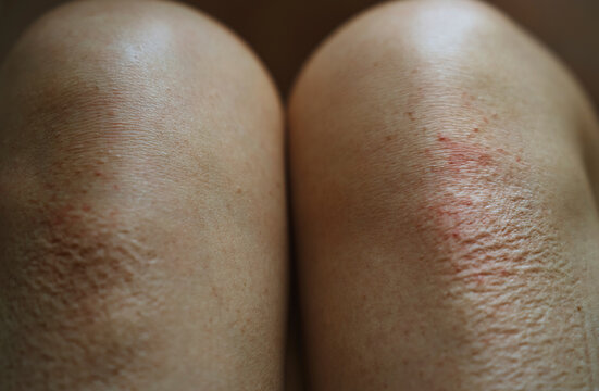 Close-up of knee skin with scar and marks showing skin imperfections