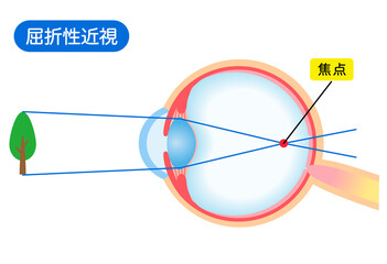 目の構造　屈折性近視　視力
