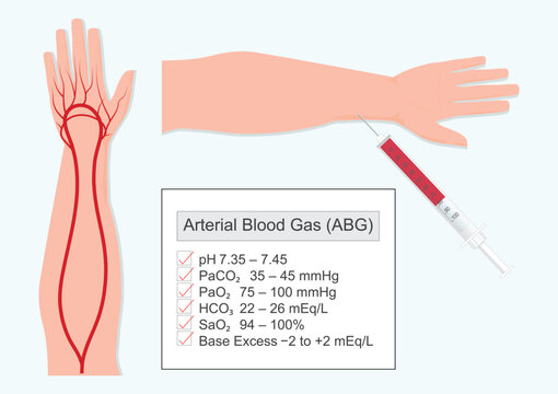 An arterial blood gas (ABG) test measures the oxygen and carbon dioxide levels in blood.