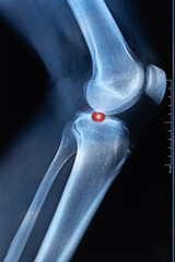 Vertical X-ray scan. Ultrasound examination of the knee joint. Exostosis on tibia. In the popliteal region, a cystic formation in the form of a Becker cyst.