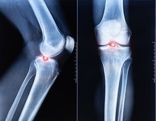 Ultrasound examination of the knee joint. Exostosis on tibia. In the popliteal region, a cystic formation in the form of a Becker cyst. X-ray scan.