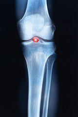 Ultrasound examination of the knee joint. Vertical X-ray scan.