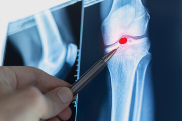 Doctor examining X-ray scan of knee joint. Exostosis on tibia. Cyst formation in the form of a Becker cyst.