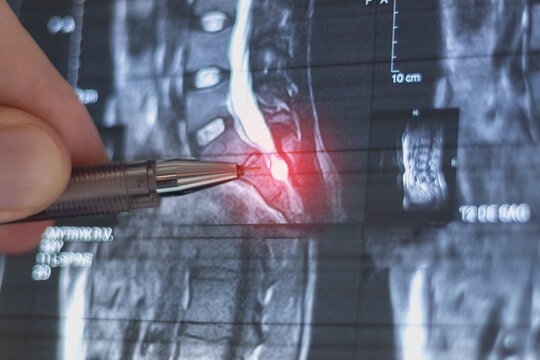 Doctor learning MRI of the lumbar spine.  At level 12, an arachnoid cyst measuring 13x14 mm is identified on the left.