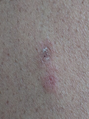 Close-up of human skin exhibiting a healing abrasion area