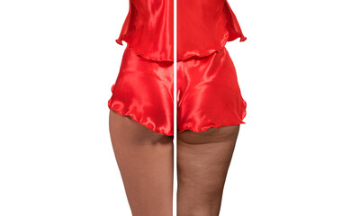 Woman's thighs and buttocks with cellulite. Before and after treatment. Concept of excess weight,...