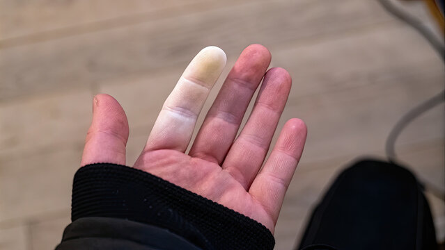 Poor circulation in finger due to Raynaud's syndrome concept. A close-up of a hand showing a bandaged finger on a wooden surface.
