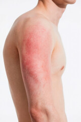 Man with red inflamed skin on upper arm and shoulder