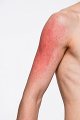 Naklejka premium Severe sunburn on young man's upper arm and shoulder