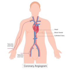 A Coronary Angiogram (CAG) is a crucial diagnostic technique.