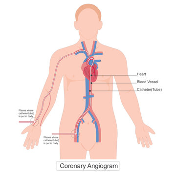A Coronary Angiogram (CAG) is a crucial diagnostic technique.