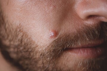 Fototapeta premium Detailed perspective of a white male s wart with an embedded hair