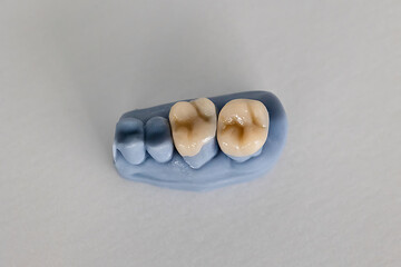 Close-up of blue dental cast showing tooth inlays and onlays. Concept of dental prosthetics, cavity...