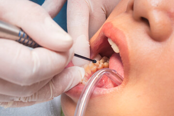 A dental professional places composite resin into a prepared cavity on the lower premolar using a ball burnisher or applicator.