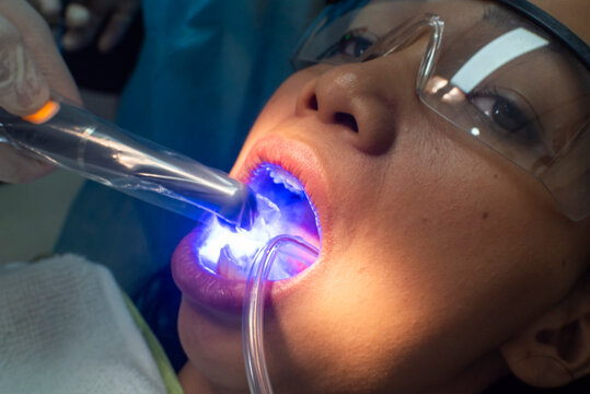 Final polymerization phase of dental composite using curing light on a lower premolar to harden the restoration material securely.