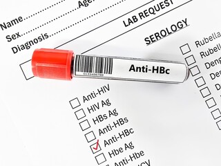 Blood sample tube and paper order request for anti-HBc test analysis.