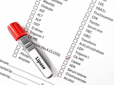 Blood sample tube and paper order request for lipase test analysis.