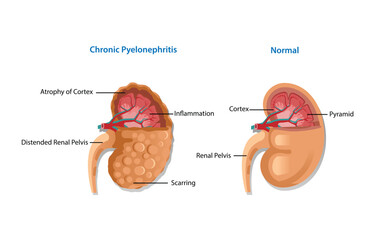 Chronic Kidney Disease of Anatomy
