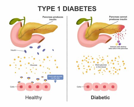Type 1 Diabetes difference between healthy vs diabetic